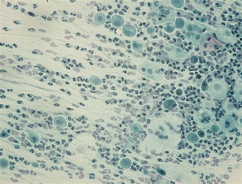 atrophic pattern pap smear|Understanding Pap Smear Results – What They .